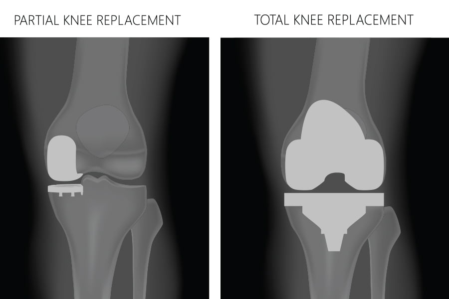 partial-vs-TKR-900x600-1.jpg__PID:6c7042be-4862-4457-b66a-dea11e0f440f